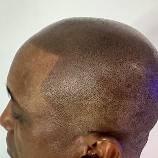 ✨ Confidence starts at the top ✨
Scalp Micropigmentation (SMP) is a non-surgical, long-lasting solut
