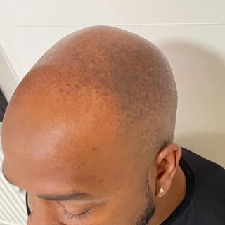 A hair solution with guaranteed results! 

When done right, scalp micropigmentation ensures that no 