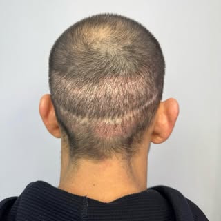 A scar doesn’t have to define your look.

Today’s transformation shows how SMP can soften, blend, an