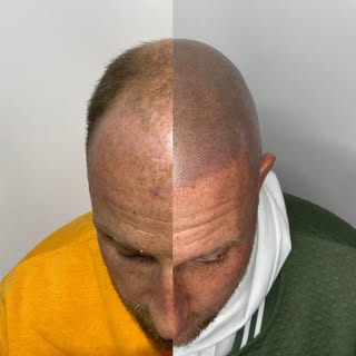 Another side by side for the win🔥

This is why I love what I do. My client came in bald, and now he