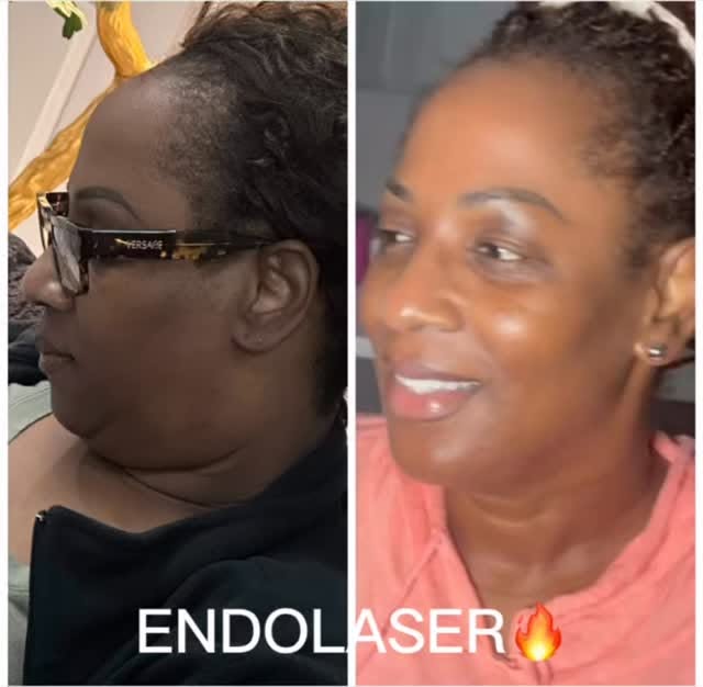 ENDOLASER🔥

If you can tell she had work done, we did too much.

Four months after Endo Laser, she 