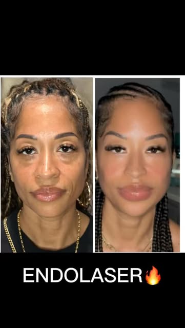 11 MONTHS AFTER ENDOLASER🔥

At 48, I knew Endolaser alone was not enough.

As we age, we naturally 