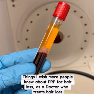 Things I wish more people knew about PRP for hair loss ⬇️

PRP works best when there are still exist