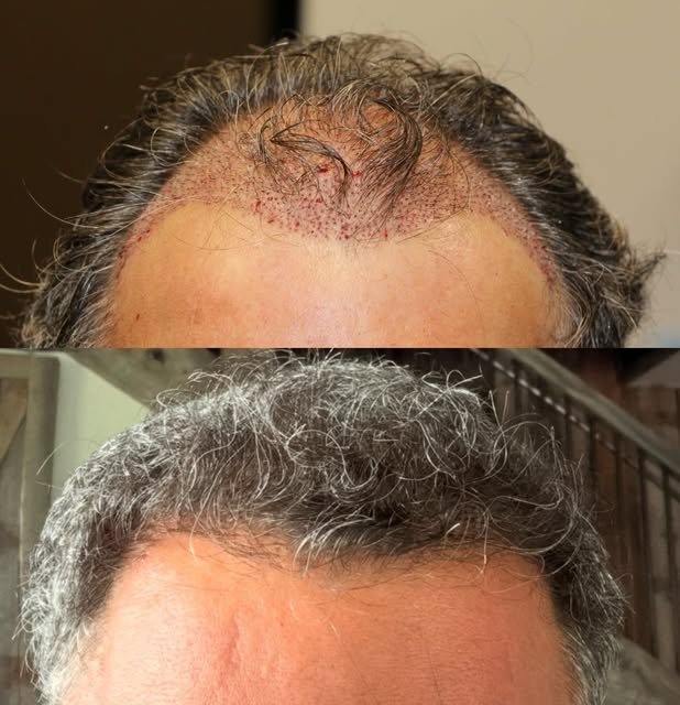 9 month FUE results. A great update from one of our FUE patients at 9 months.

For this patient, we 