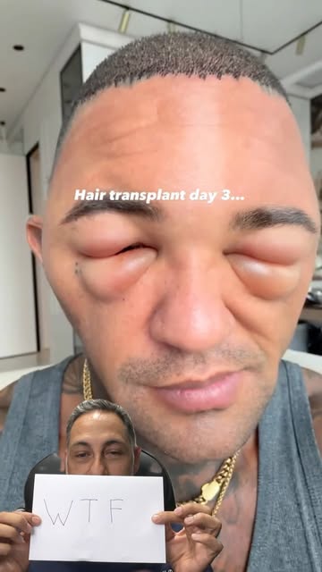Is this amount of swelling normal after a hair transplant? 

Dr. Yazdan reacts to a video showing a 
