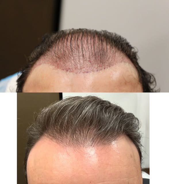 11 months post FUT! 

This patient came in looking to improve his hairline and add more density thro