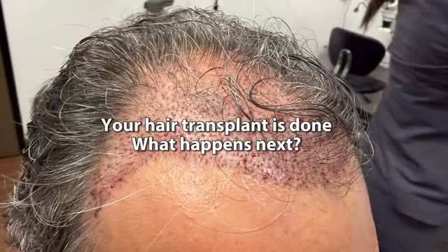 Your hair transplant is done… now what?

The first two weeks are an important part of the healing pr