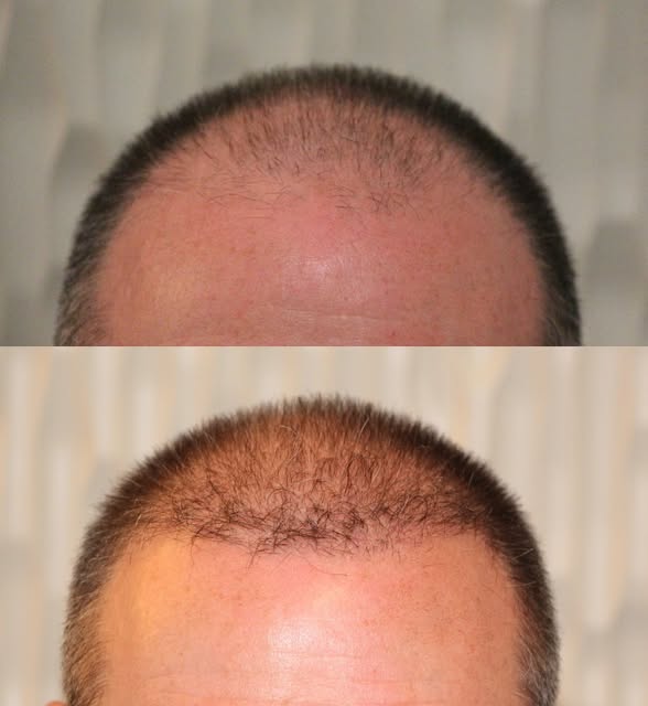 6 months after FUE 🙌

Already seeing a noticeable improvement in the hairline and frontal density, 