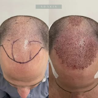 HAIR TRANSPLANT. Amazing result using the NeoGraft machine for hair restoration

Losing hair, especi