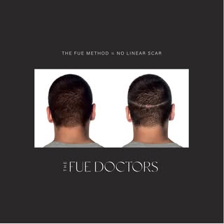 With the hair loss process often starting so early in life for both men and women, it’s no secret th