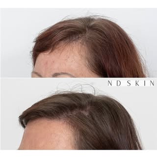 HAIR TRANSFORMATION 👏👏

Only 8 weeks after a HAIR transplant to increase density and also thicken 