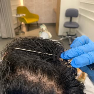 #mesotherapy #hairhealth #mydubai