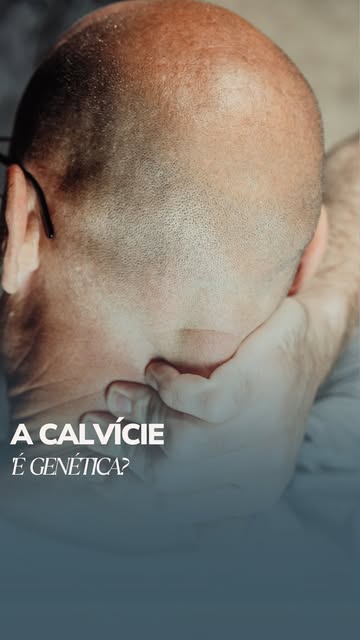 A genética tem um papel importante na calvície, mas ter um pai calvo não significa que você necessar