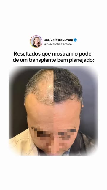 Cada paciente tem uma necessidade diferente. Por isso, um transplante bem planejado considera a linh