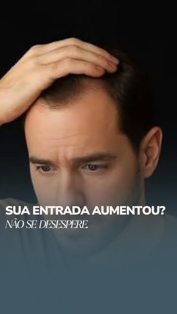Entradas mais aparentes não significam necessariamente que você esteja evoluindo para a calvície. An