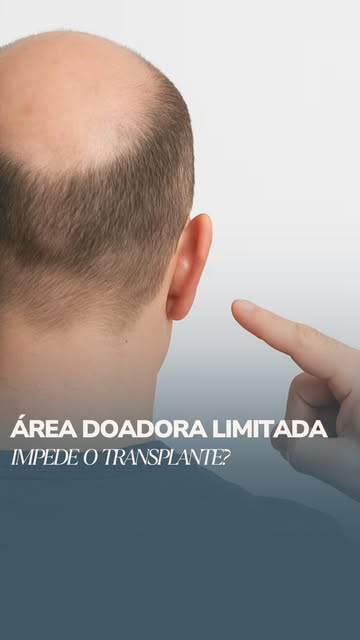 Ter uma área doadora limitada não significa, necessariamente, que o transplante esteja descartado. O