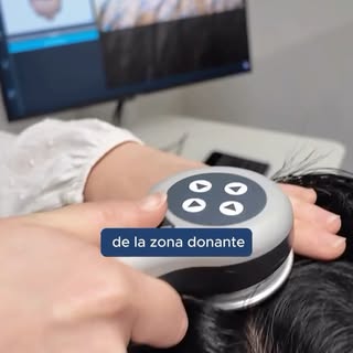 Antes de tomar una decisión sobre un trasplante capilar, es importante separar los mitos de la reali