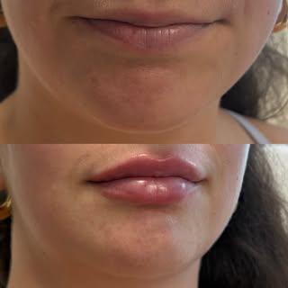 Before & immediately after 💋
Just 0.5 mL of Versa to add a subtle, natural plump🫦
#lipfiller #natu