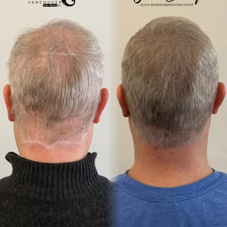 White hair. Failed hair transplants. A second chance.

One of the biggest misconceptions about Scalp