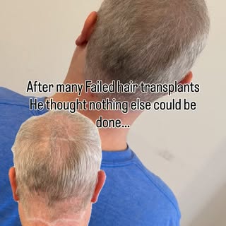 From failed hair transplants… to finally loving what he sees in the mirror.

Yes, this is Scalp Micr