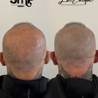 The back of the scalp is one of the hardest areas to perfect.

The crown swirl, existing hair, natur