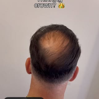 When your crown starts thinning, every bright light and every mirror becomes a reminder.

Scalp Micr