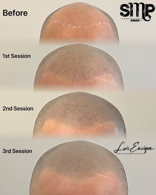 This is why scalp micropigmentation is built over 3 carefully planned sessions.

1st session: We est
