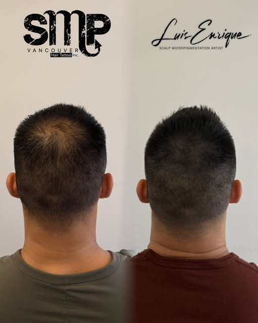 This is what a properly planned SMP density treatment looks like.

The goal wasn’t to make his scalp