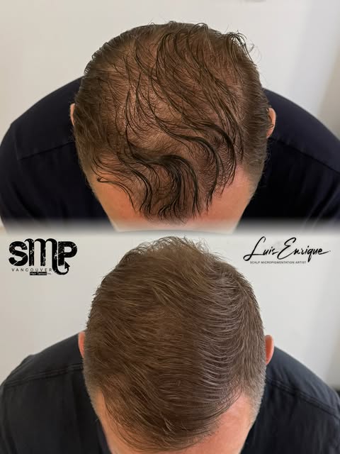 Density SMP on brown/light hair. 

Scalp micropigmentation isn’t only for dark hair.

For this clien