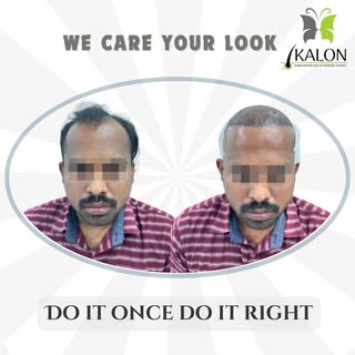 ✨ Regain Confidence, Redefine Yourself ✨
At KALON Hair Transplant & Cosmetic Clinics, we believe you