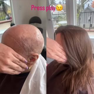 ✨ The Art of Confidence: Understanding Custom CNC Hair Prosthetics ✨

For anyone experiencing alopec