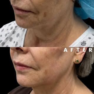 A more defined jawline and neck can make a beautiful difference in your overall facial profile. 

Th