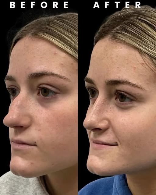 Small changes can make a meaningful difference.

This rhinoplasty result is a beautiful example of h