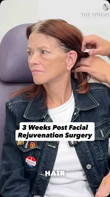 Three weeks after her extended deep plane facelift, neck lift, and fat grafting to the eyes, and she