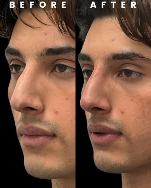 Not every nose concern requires surgery. Non-surgical rhinoplasty with filler can be used to strateg