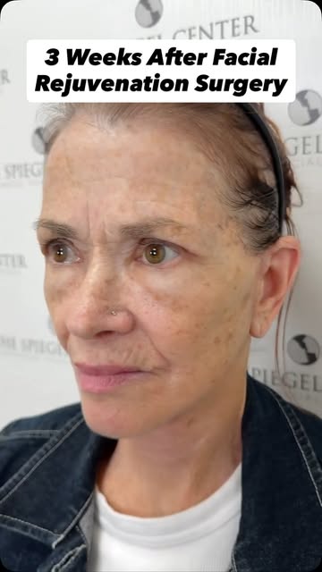 Facelift recovery doesn’t happen overnight, and this timeline is a great example of how quickly thin