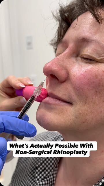 What can you actually change with a non-surgical rhinoplasty? More than you might think.

With the r