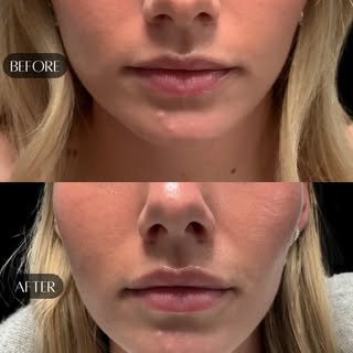 Lip flip results giving everything this girl needs 👄
