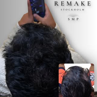 HELT ÄRLIGT❗️

Om du har mörkt hår (svart, brunt) och är tunnhårig, testa en scalp micropigmentation