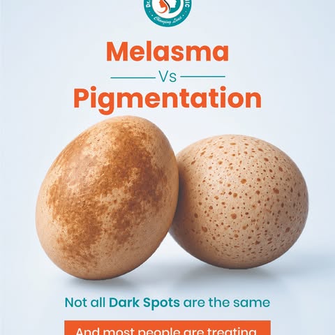 Face par Brown Patches hain…
Toh kya ye normal Pigmentation hai ya Melasma? 🤔

Dono dekhne mein sim