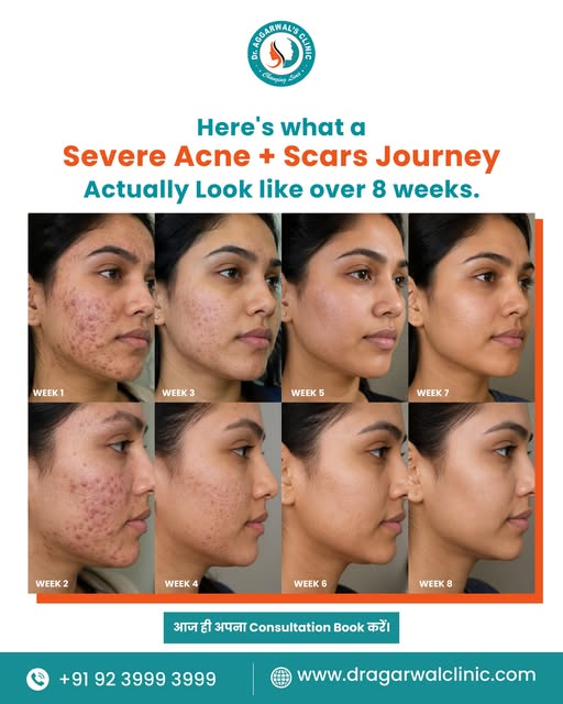 Severe Acne se Acne Scars tak… ✨
This is not just a skin transformation.
 It’s a journey. ❤️

Active