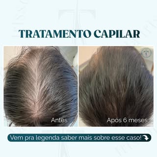 Este paciente chegou à Clínica incomodado com as entradas e couro cabeludo mais aparente, caso típic