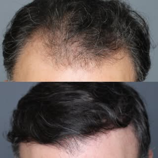 Welcome to Austin Hair Restoration, where we make your hair dreams come true. This is the before and