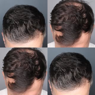 Motivation Monday! 

Who says new beginnings have to start in January? A hair transplant typically s