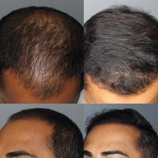 Ready to take control of your hair loss? Contact our office today to schedule a free consultation wi