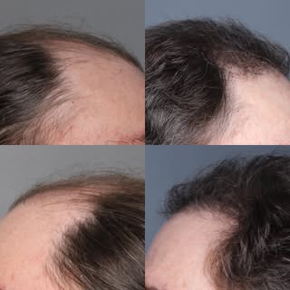 🧨 DEAL ALERT 🧨

We had a last minute cancellation for a procedure date next week. If you are inter