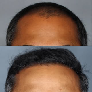 Welcome to Austin Hair Restoration, where we make your hair goals come to life. Give us a call to sc