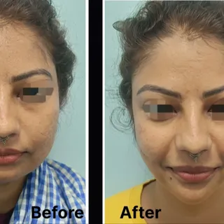 Chin implant surgery result 

Dr. Sumeet jaiswal
MBBS, MS, MCH, (Plastic surgeon)

Zenith cosmetic &