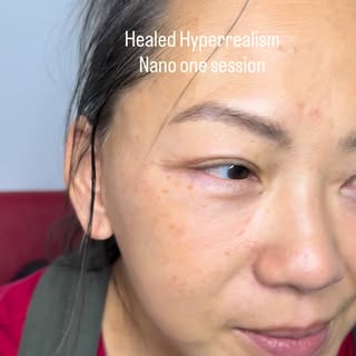 ✨ HyperRealism Nano — Healed After ONE Session ✨

This is HyperRealism Nano, healed after one sessio