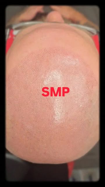 Nobody needs to know you had SMP… unless YOU want them to. 👀

That’s the beauty of natural-looking 